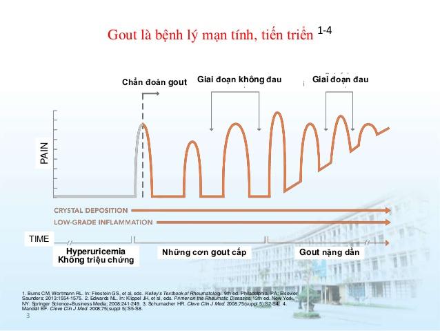 Các giai đoạn tiến triển của bệnh Gút
