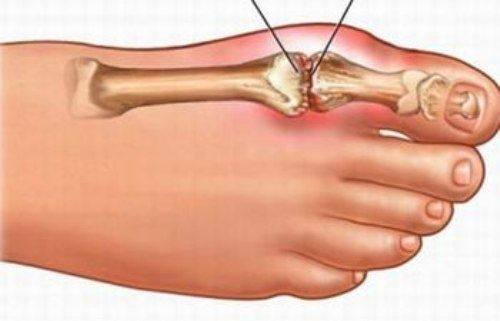 Bệnh gút là gì?