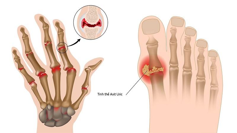 Cảnh báo: Sử dụng Allo.purinol gây nhiều tác dụng phụ nghiêm trọng đối với người bệnh gút