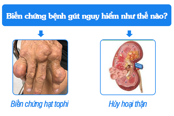 Biến chứng bệnh gút nguy hiểm như thế nào?