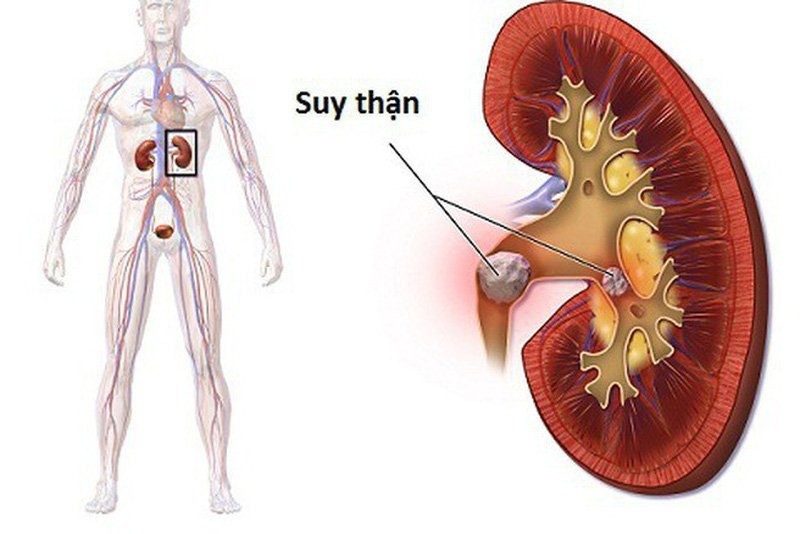 Biến chứng suy thận do bệnh gút