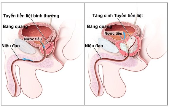 Hình ảnh mô tả u xơ tuyến tiền liệt