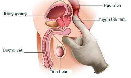 Thăm khám trực tràng kiểm tra u xơ tuyến tiền liệt