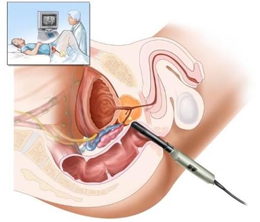 Kỹ thuật siêu âm tuyến tiền liệt qua trực tràng được sử dụng phổ biến