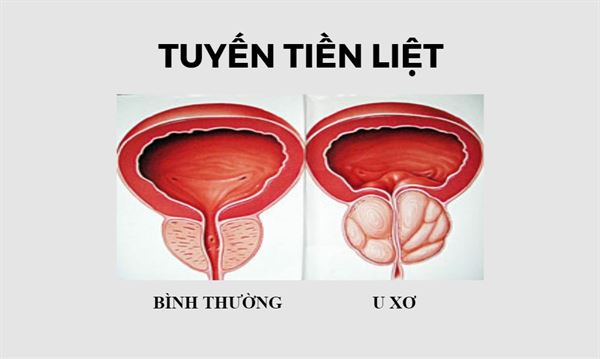 U xơ tuyến tiền liệt có nguy hiểm không?