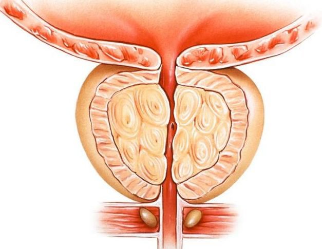 Tác dụng của kẽm với người mắc bệnh phì đại tuyến tiền liệt là gì?