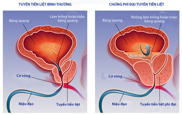 Tuyến tiền liệt phì đại chèn ép vào bàng quang và niệu đạo gây tiểu không hết