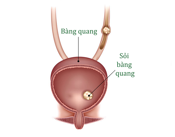 Ứ đọng nước tiểu sẽ gây tạo sỏi bàng quang