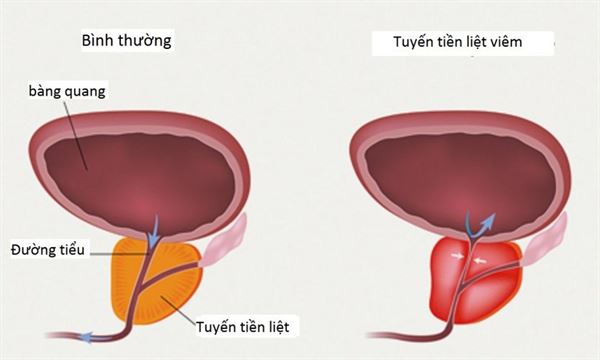 Biện pháp phòng ngừa viêm tuyến tiền liệt cho người mắc phì đại tuyến tiền liệt là gì?