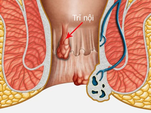 Bệnh trĩ nội là gì? Tổng quan từ a-z (2020)