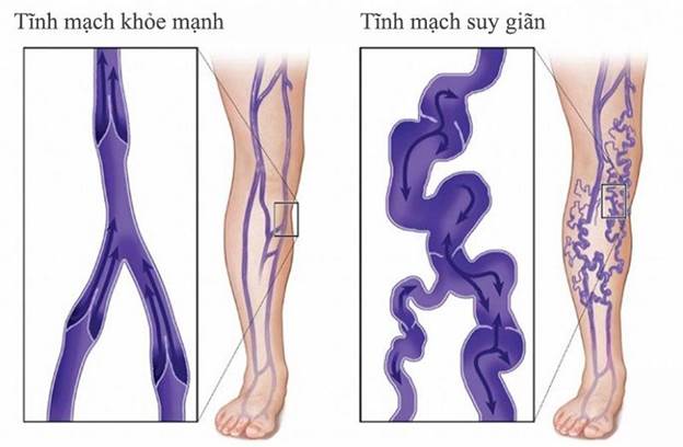 Suy van tĩnh mạch chi dưới: lựa chọn phương pháp điều trị phù hợp theo phân độ