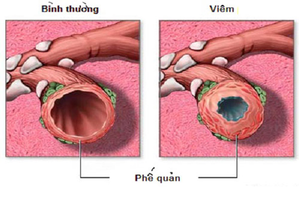 Bệnh viêm phế quản mãn tính là gì