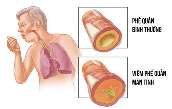 Viêm phế quản mãn tính là gì