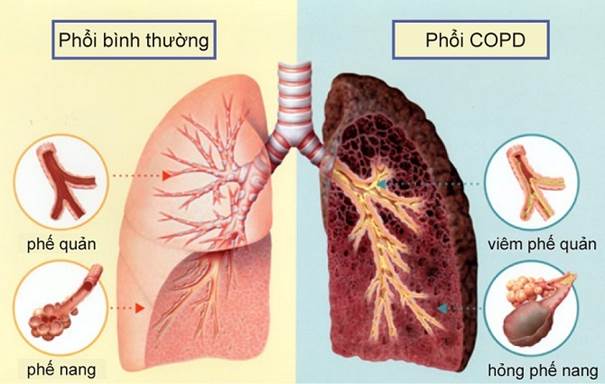 Hỏi: Hỗ trợ giải độc phổi có tác dụng gì với bệnh phổi tắc nghẽn mãn tính COPD