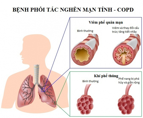 Các phương pháp đơn giản giúp người bệnh phổi tắc nghẽn mạn tính hít thở dễ dàng