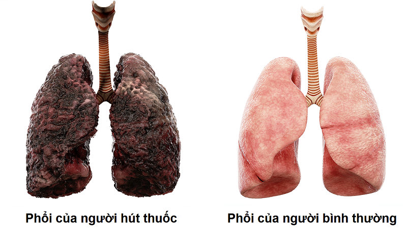 Phổi của người hút thuốc thay đổi so với bình thường như thế nào?