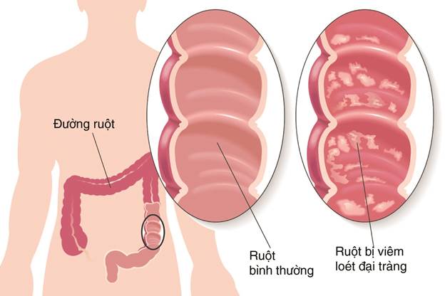 viêm đại tràng mãn tính