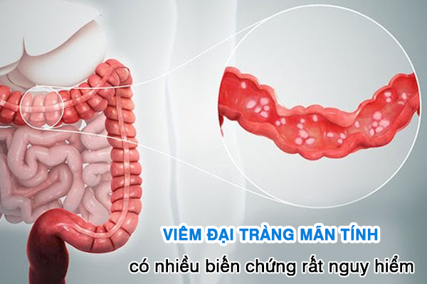 Viêm đại tràng mãn tính có nhiều biến chứng rất nguy hiểm