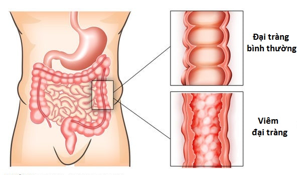 Nguyên nhân và triệu chứng bệnh viêm đại tràng là gì