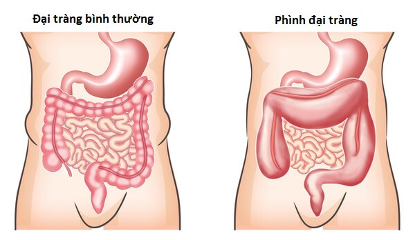 4 biến chứng nguy hiểm khôn lường của bệnh viêm đại tràng mạn tính