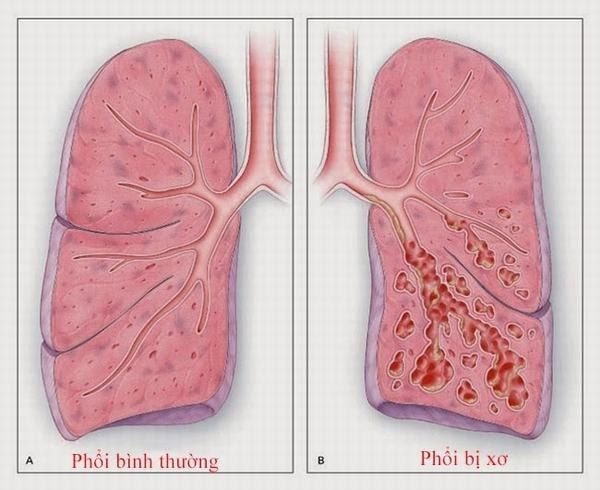 Kết quả hình ảnh cho bệnh xơ phổi