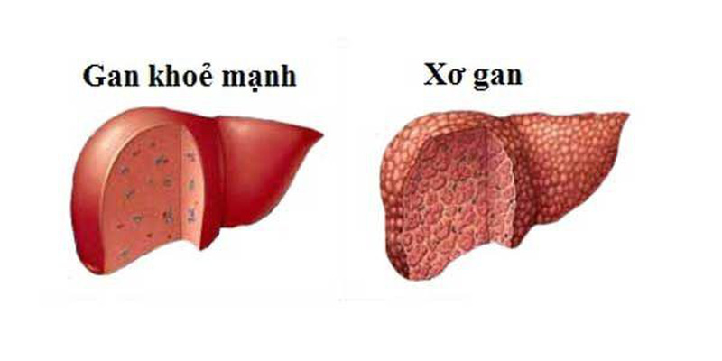 Bệnh xơ gan do uống rượu