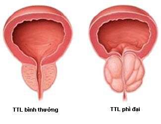 Phì đại tiền liệt tuyến - Nguyên nhân và giải pháp